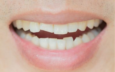 What Can Be Done When You Have A Broken Tooth? (Remedies)