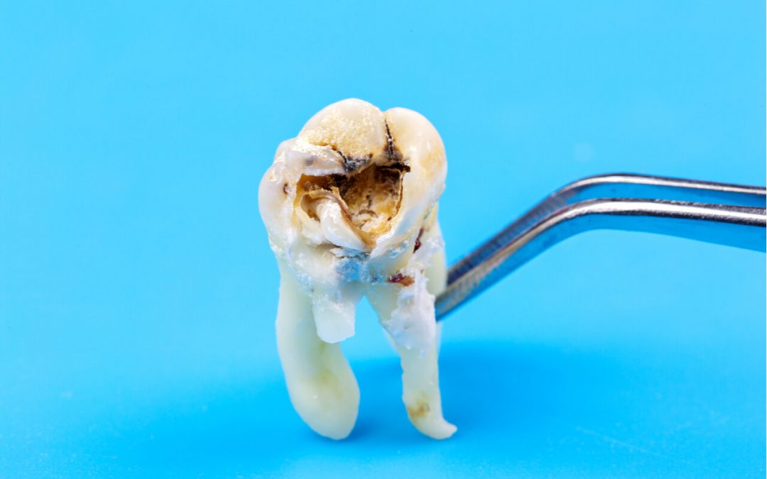 Broken Wisdom Tooth (How It Is Caused And What To Do)