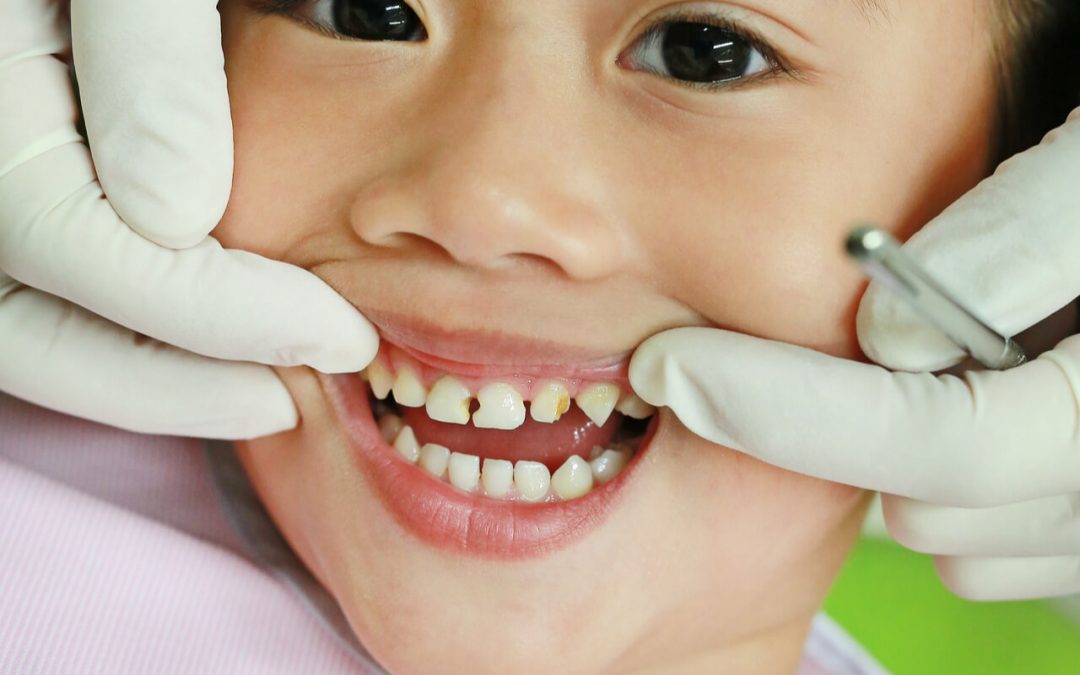 fixing the child's broken tooth