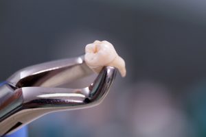 extraction of tooth
