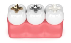 dental filling types
