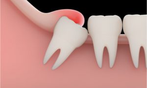 impacted wisdom tooth pain