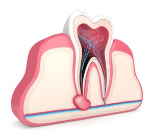 tooth nerve infection