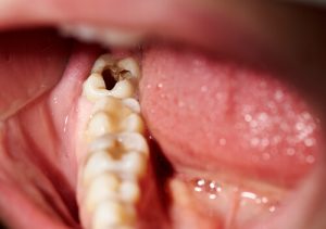 pain from cavities