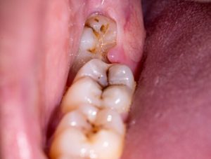 throbbing tooth pain from impacted wisdom tooth