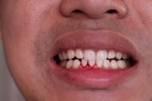 gingivitis causes and treatment