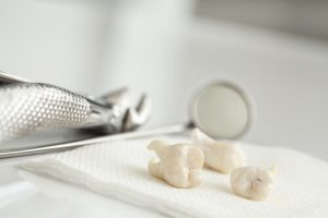 tooth extraction recovery
