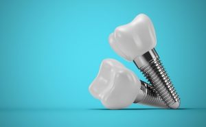 dental implant composition