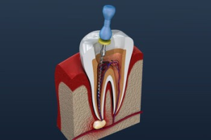 root canal firle